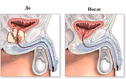 Фото: Эректильная дисфункция после простатэктомии