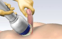 Фото: Ударно-волновая терапия при эректильной дисфункции